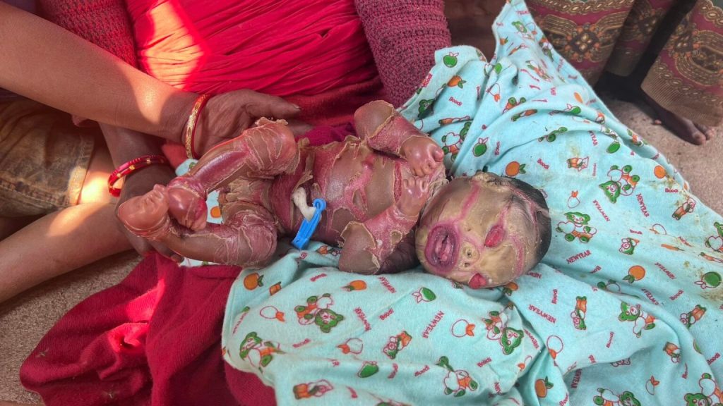 गुल्मीको ईस्मा तोरिपाटामा गोमा नेपालीले जन्माइन् अनौठो बच्चा